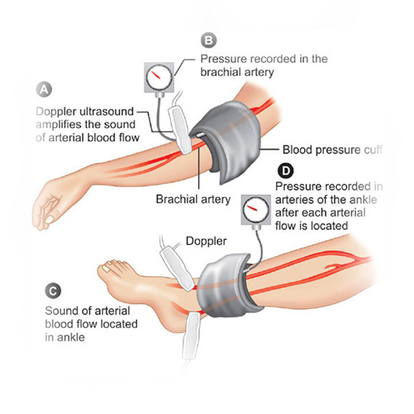 Arterial Doppler Ultrasound