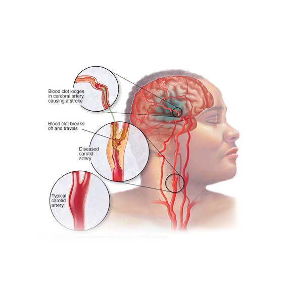 Carotid Doppler Ultrasound