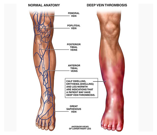 Deep Vein Thrombosis