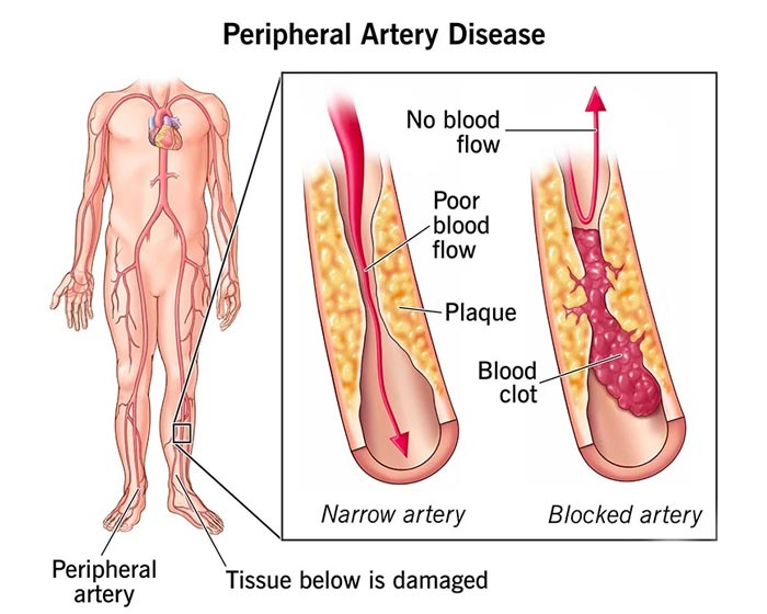 Peripheral Artery Disease