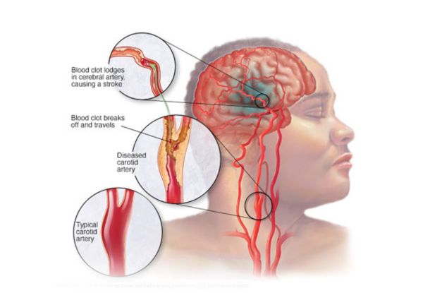 Carotid Doppler Ultrasound