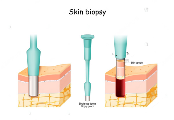 Types of Biopsy Tests