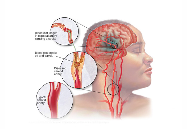 Carotid Doppler Ultrasound