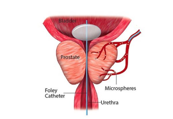 Prostate Artery Embolization