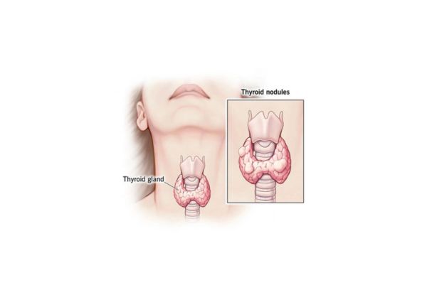 thyroid nodule