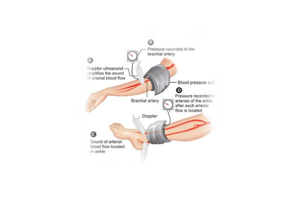 arterial doppler ultrasound