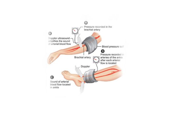 Arterial Doppler Test