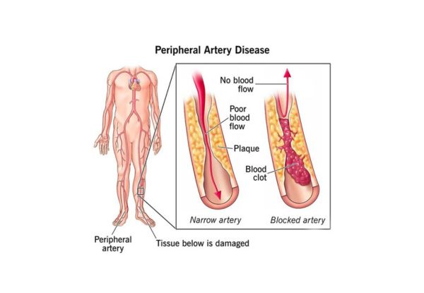 Peripheral Artery Disease in Women