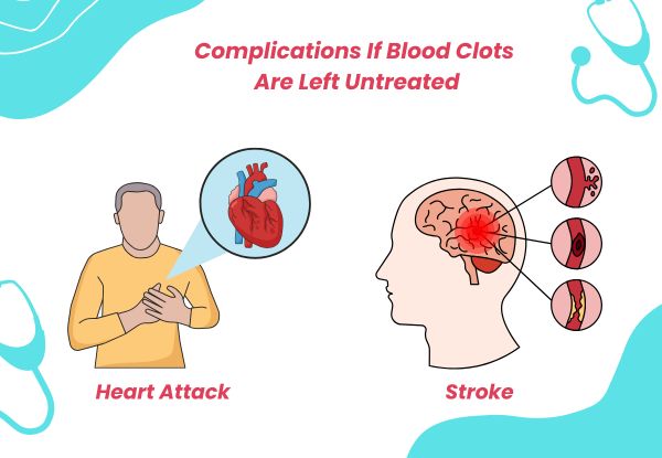 Complications If Blood Clots  Are Left Untreated