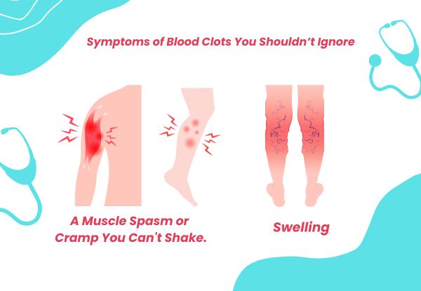 Symptoms of Blood Clots You Shouldn’t Ignore