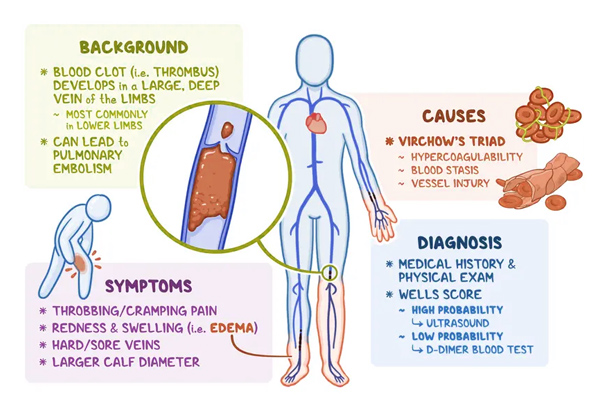 An infographic detailing the cause, signs and symptoms, diagnosis,  and treatment of Deep Vein Thrombosis.