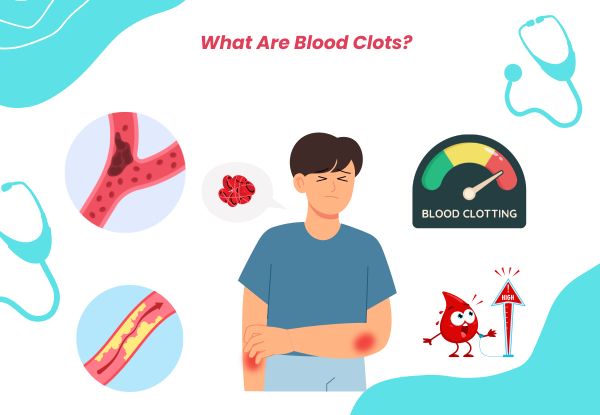 What Are Blood Clots