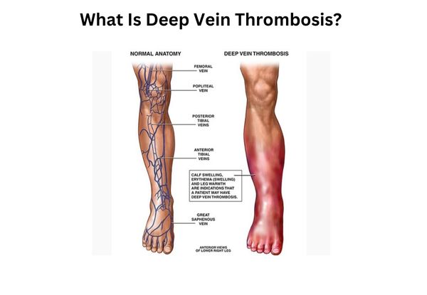 what is deep vein thrombosis