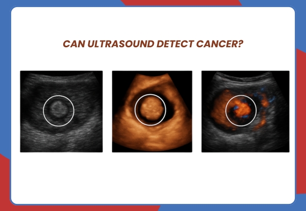 Can ultrasound detect cancer?