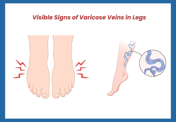 Visible Signs of Varicose Veins in Legs