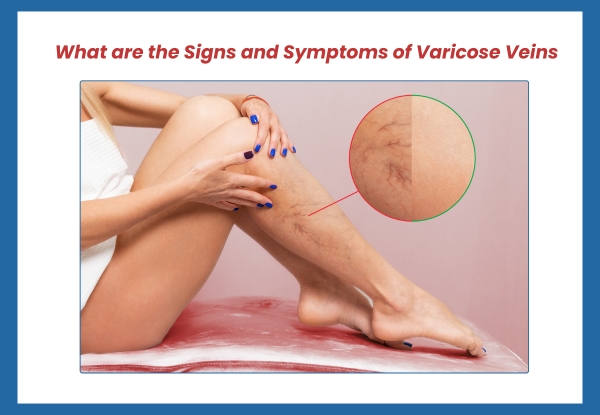 What are the signs and symptoms of varicose veins?