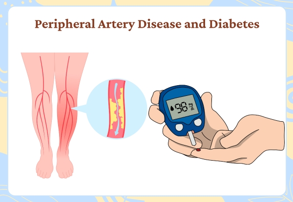 Peripheral Artery Disease and Diabetes