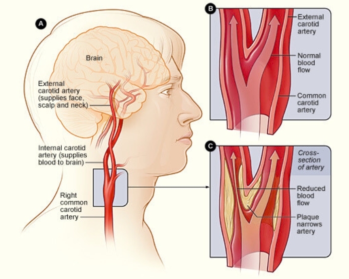 Carotid Doppler Radiology