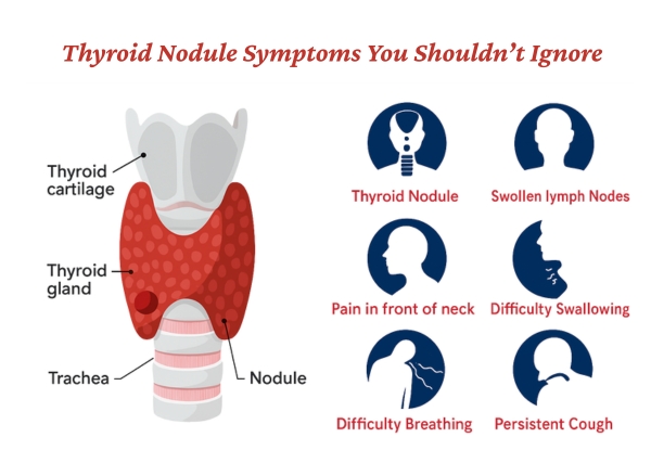 Thyroid Nodule Symptoms You Shouldn’t Ignore
