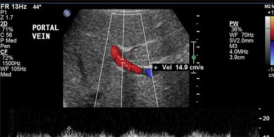 Abdominal Doppler Study Portal Vein Doppler