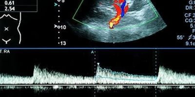 Arterial-Doppler-Study