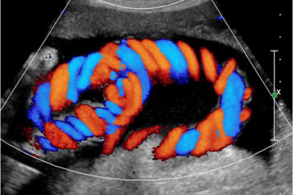 Color-Doppler-Sonography2