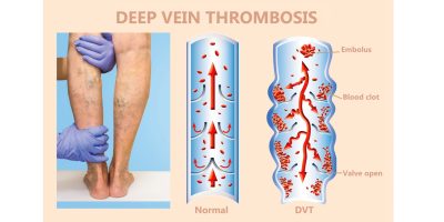 Deep Vein Thrombosis