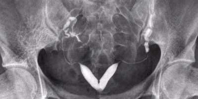 Hysterosalpingogram (HSG)