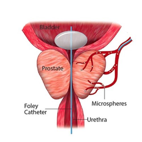 prostate artery embolization