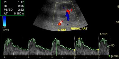 Renal Doppler Study