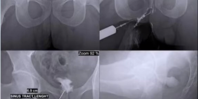 SINOGRAM - FISTULOGRAM