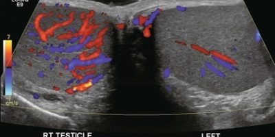 Scrotal-Doppler-Study