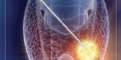 Thyroid Nodule Ablation-1