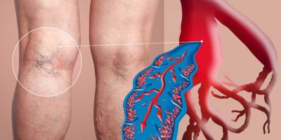 Varicose Veins, Peripheral Arterial Disease